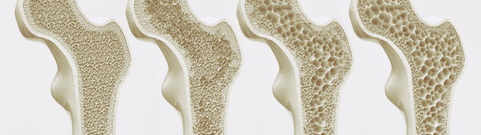 Cos'è l'osteoporosi