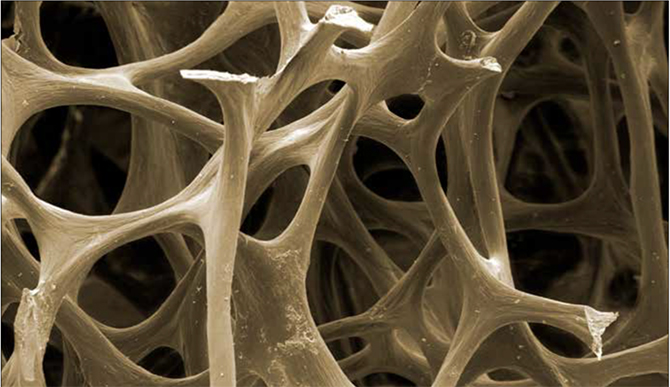 what is osteoporosis?